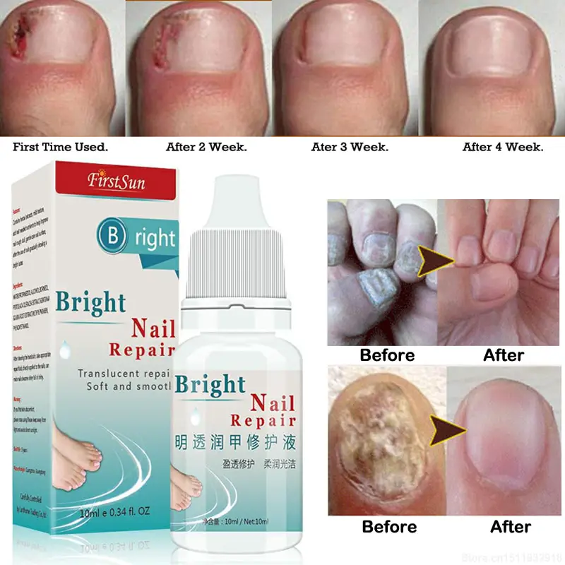 10ml Nail Fungus Treatment Cream Onychomycosis Paronychia Anti Fungal ...