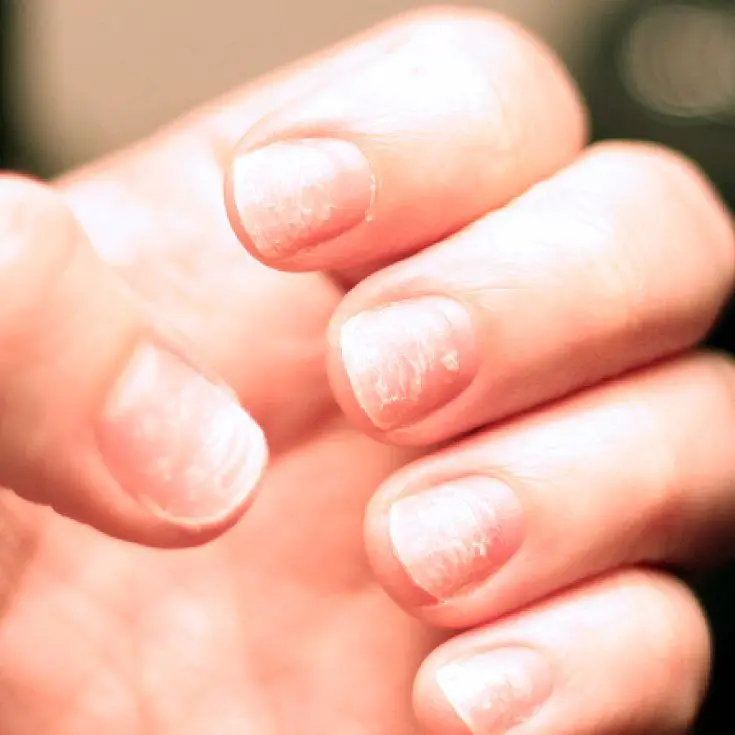 Cracked Skin on Fingers Around Nails  Causes and Treatment