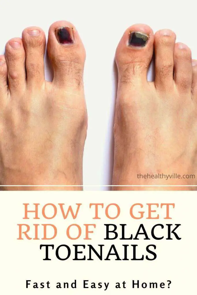 How to Get Rid of Black Toenails Fast and Easy at Home?