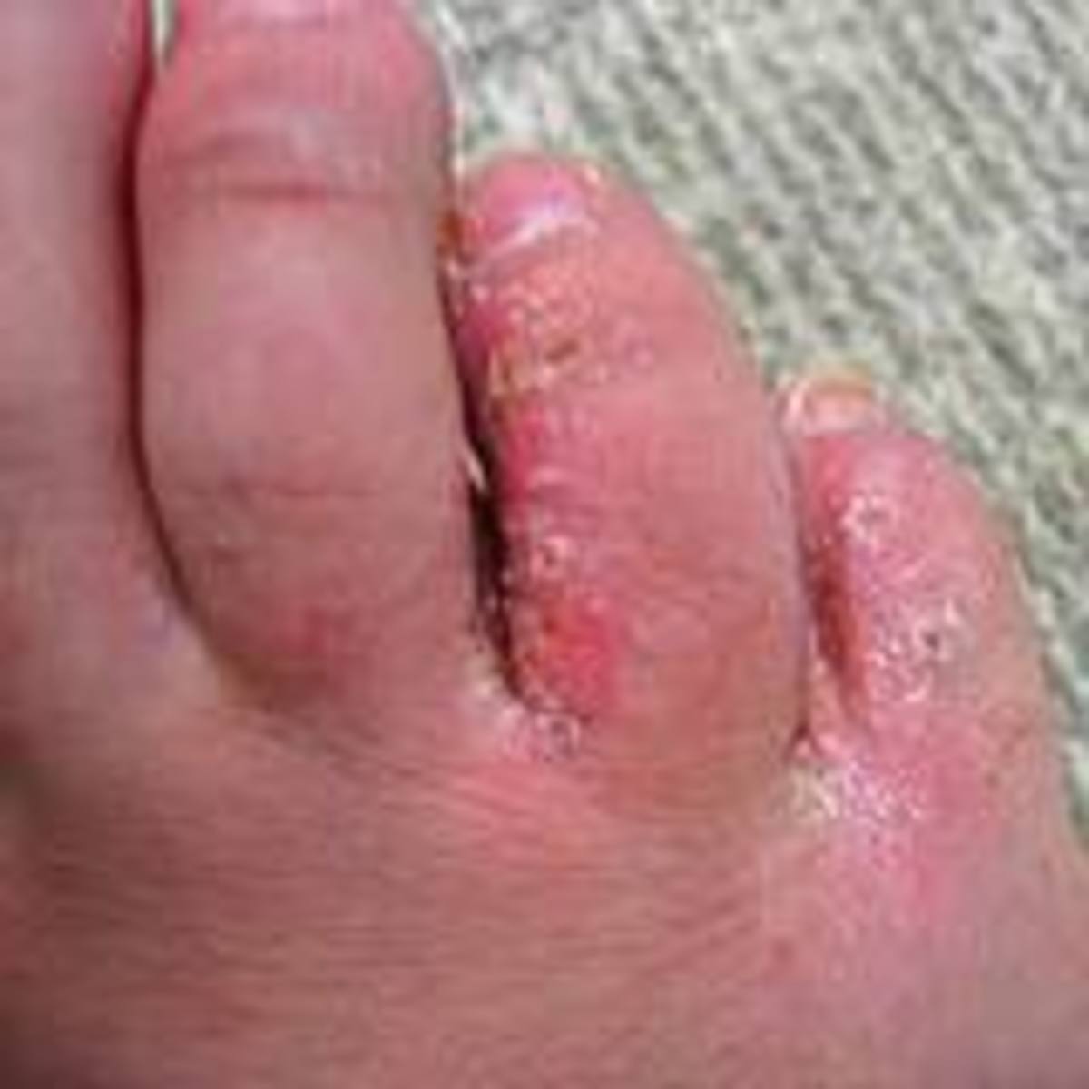 Suitable Foot Fungus Treatments