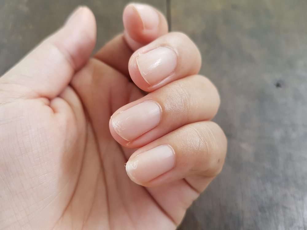 Why Do My Nails Peel And Break